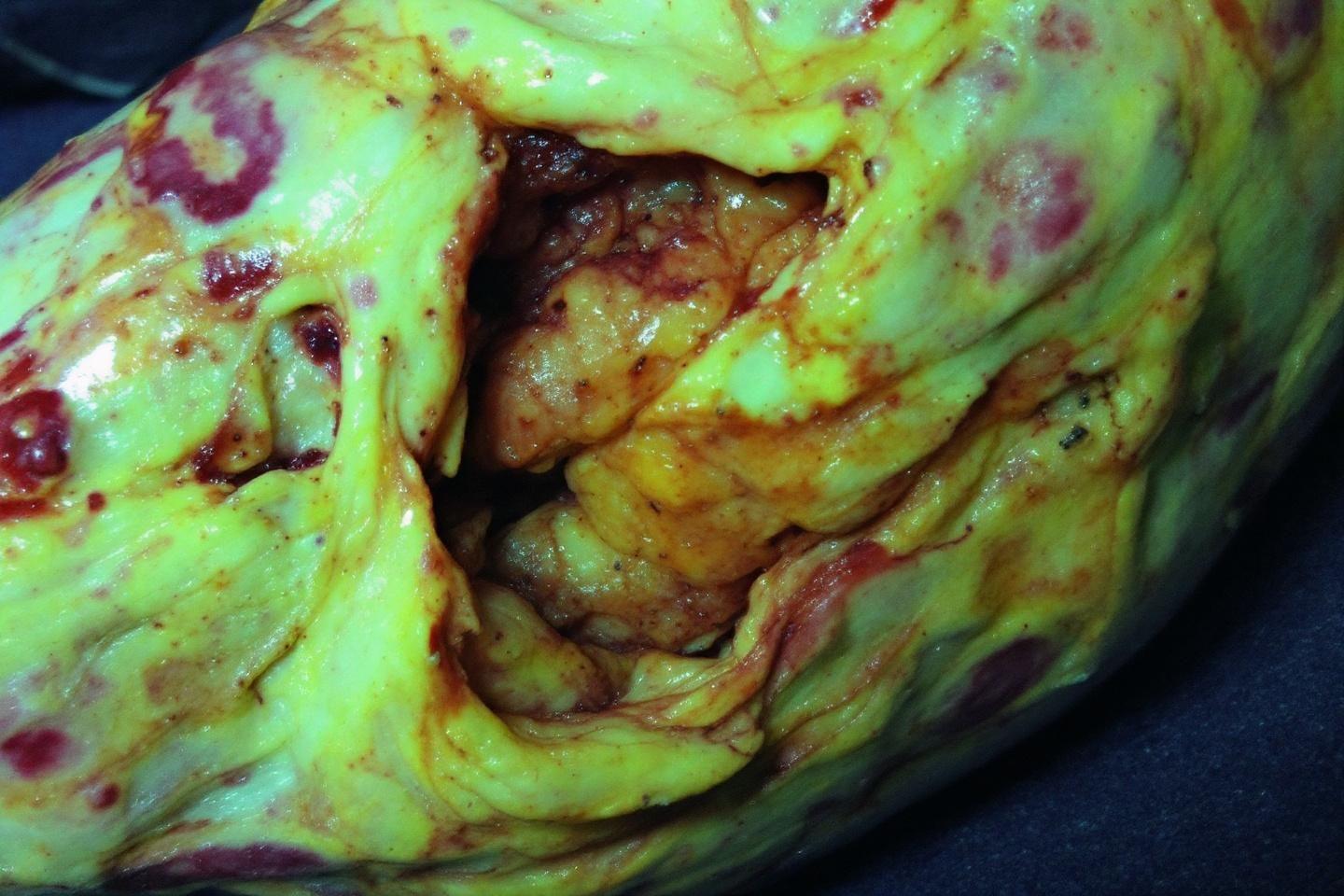 Bursite du coude (hygroma) : définition, symptômes et traitements médicaux