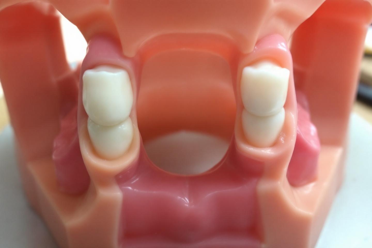 Prothèse dentaire Valplast : remboursement et prise en charge par la sécurité sociale