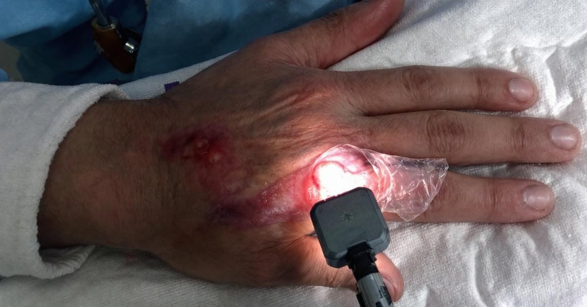 Dakin panaris traitement symptomes soins guerir rapidement featured